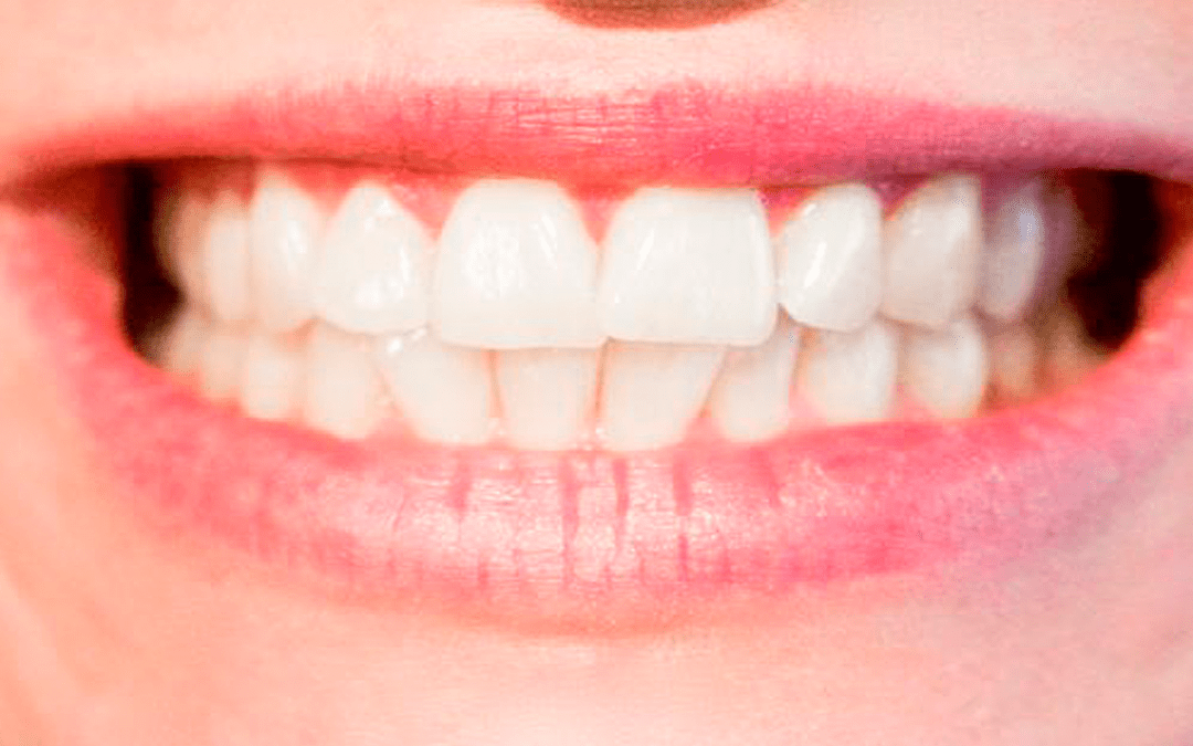 Starke weiße Zähne brauchen starke weiße Keramikfüllungen